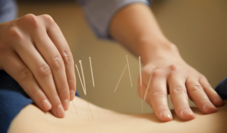 Los Angeles Acupuncture
